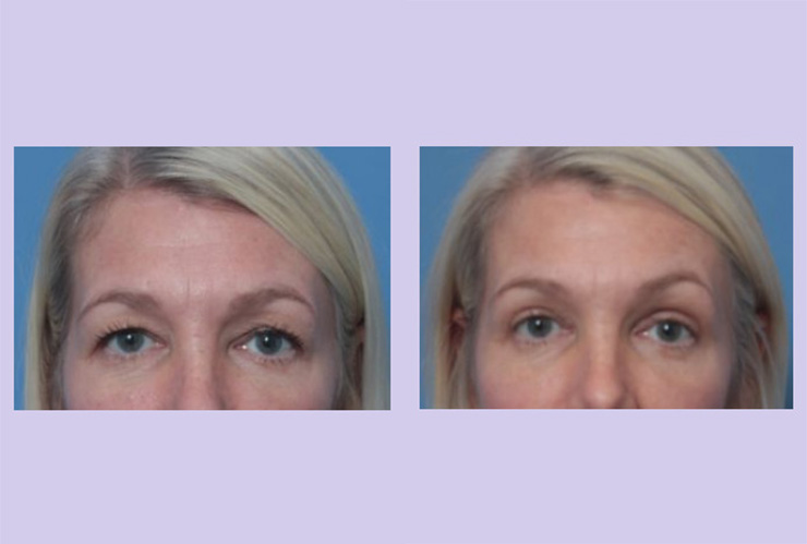 Before and After Image: Upper Blepharoplasty – Case 43 - front