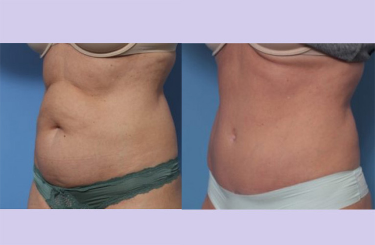 Before and After Image: Abdominoplasty – Tummy Tuck – Case 37 - left-front-oblique