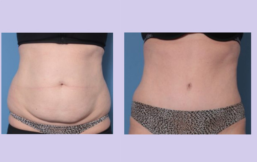 Before and After Image: Abdominoplasty – Tummy Tuck – Case 38 - front