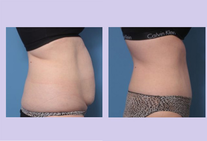 Before and After Image: Abdominoplasty – Tummy Tuck – Case 38 - right-side