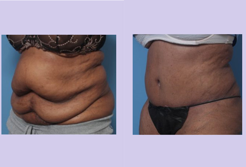 Before and After Image: Abdominoplasty – Tummy Tuck – Case 38 - left-front-oblique
