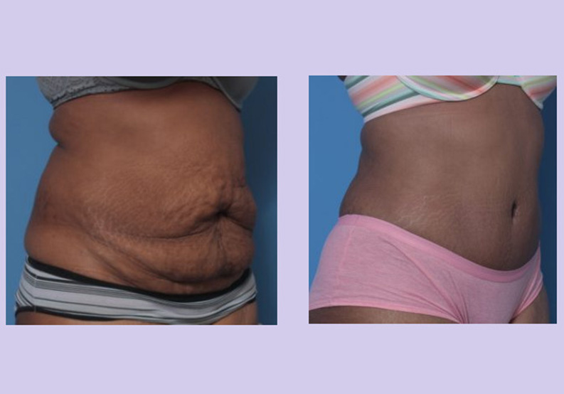 Before and After Image: Abdominoplasty – Tummy Tuck – Case 39 - right-front-oblique