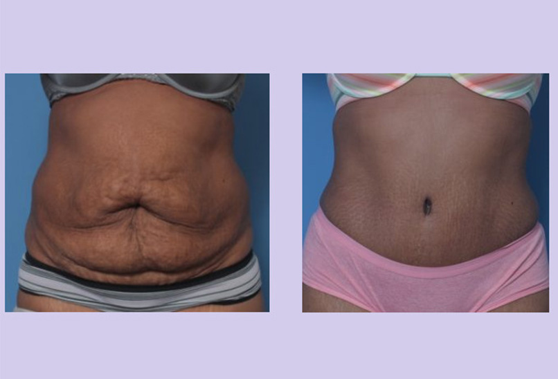 Before and After Image: Abdominoplasty – Tummy Tuck – Case 39 - front