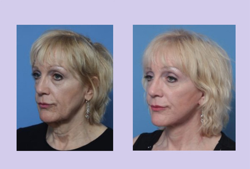 Before and After Image: 3-D Volumetric Facelift – Case 16 - left-front-oblique