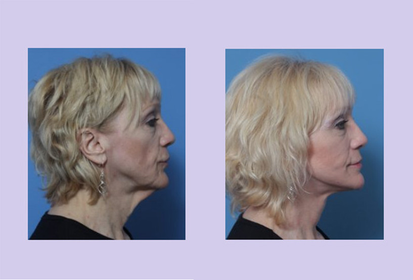 Before and After Image: 3-D Volumetric Facelift – Case 16 - right-side