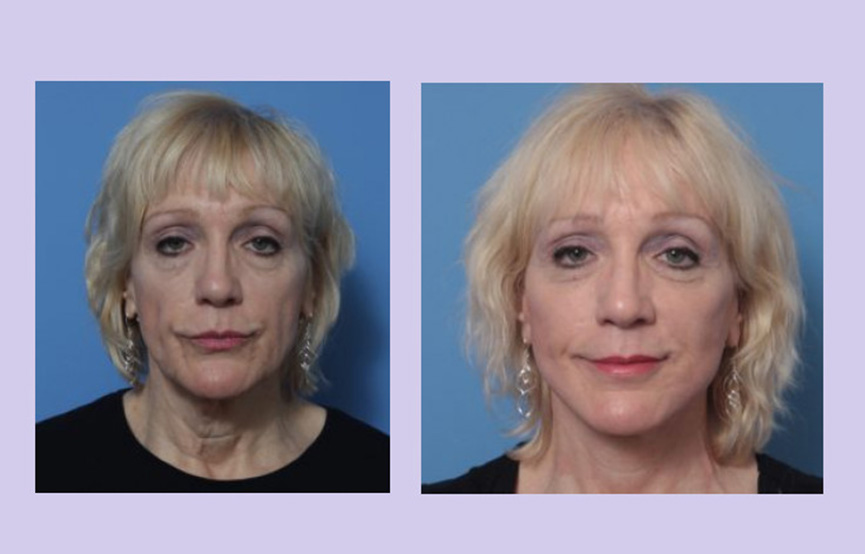 Before and After Image: 3-D Volumetric Facelift – Case 16 - front