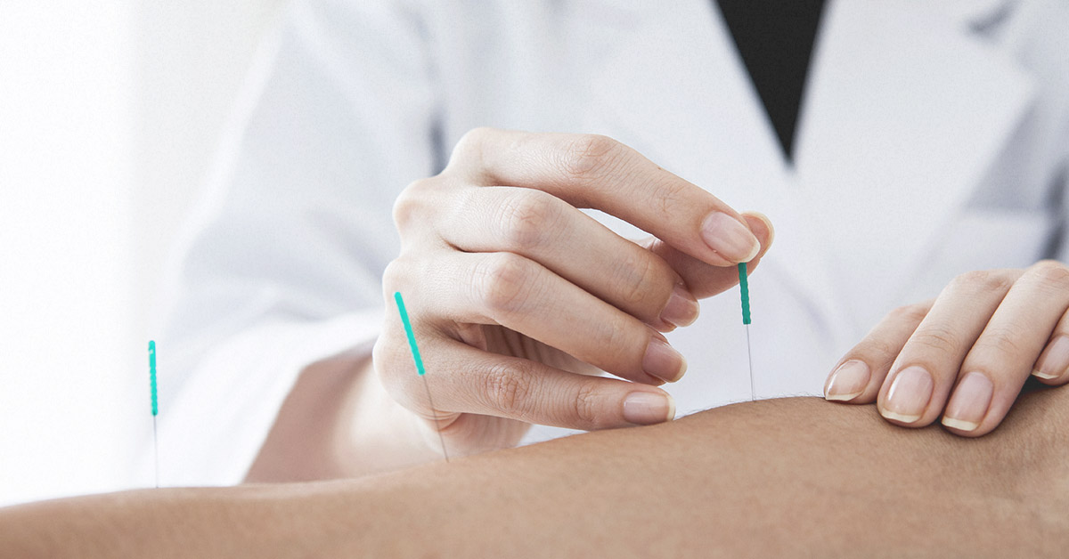 Accupuncture