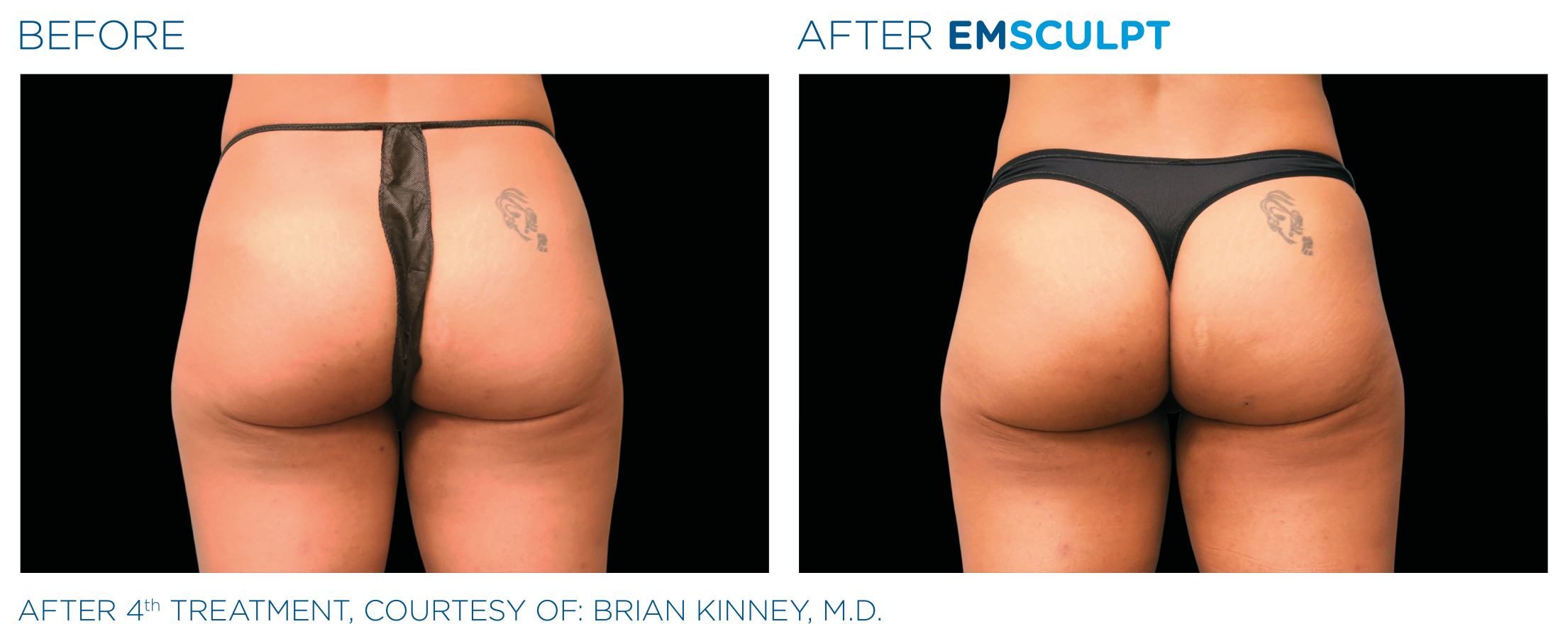 EmSculpt Butt2