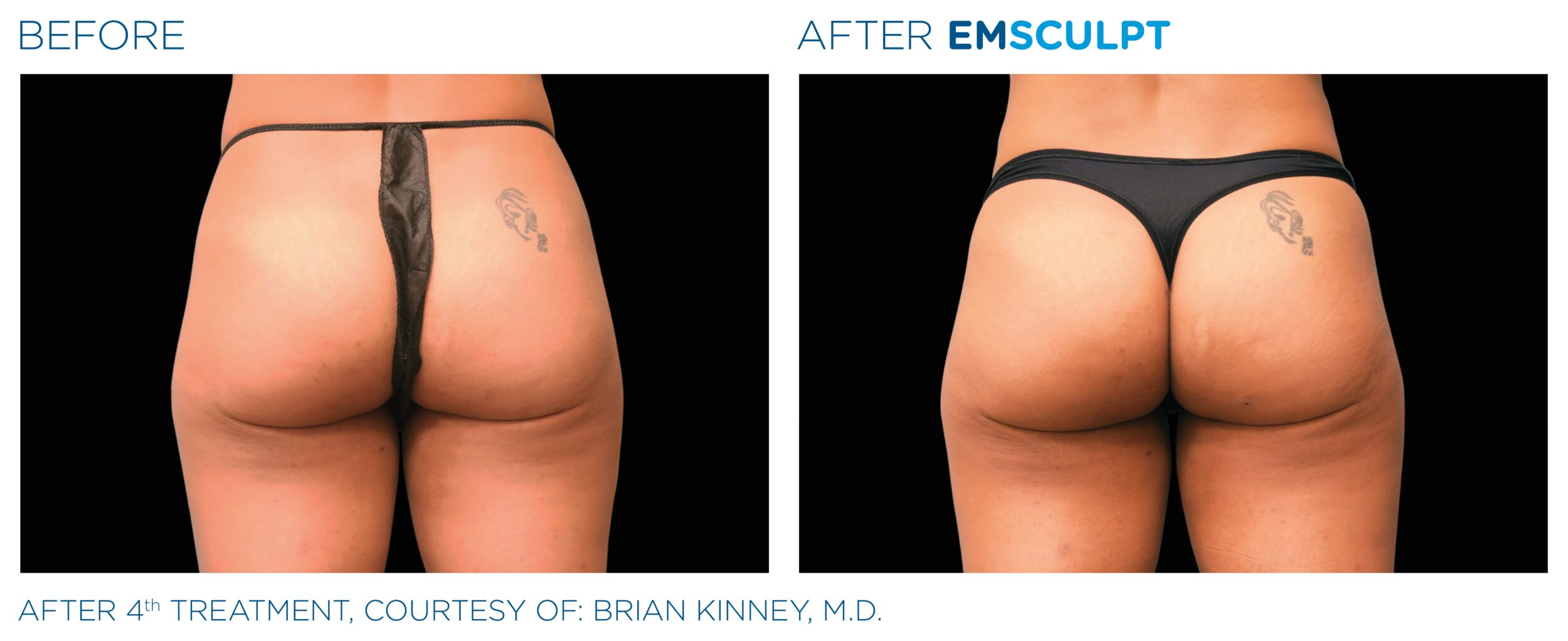 EmSculpt3 2
