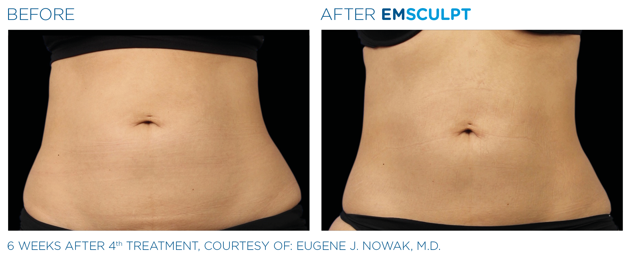 EmSculpt Abs