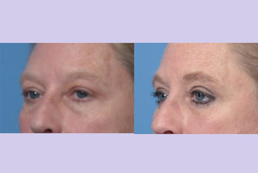 Before and After Image: Upper and Lower Blepharoplasty – Case 44 - other
