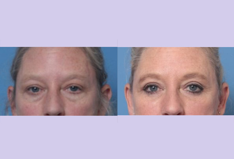 Before and After Image: Upper and Lower Blepharoplasty – Case 44 - front