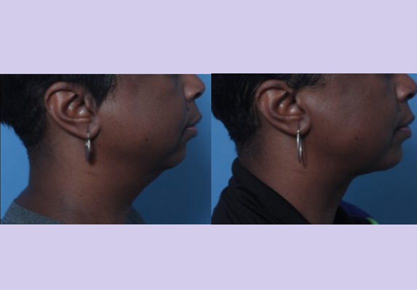 Before and After Image: Submental liposuction – Case 5 - right-side