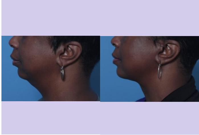 Before and After Image: Chin Augmentation – Case 6 - left-side