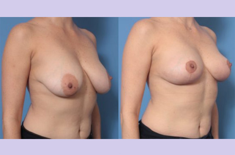 Before and After Image: Breast Lift- Case 25 - right-front-oblique