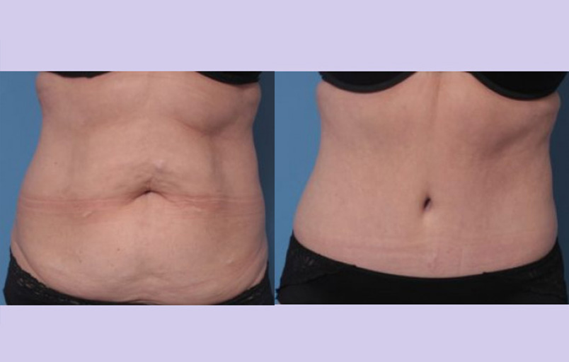 Before and After Image: Abdominoplasty – Tummy Tuck – Case 40 - front