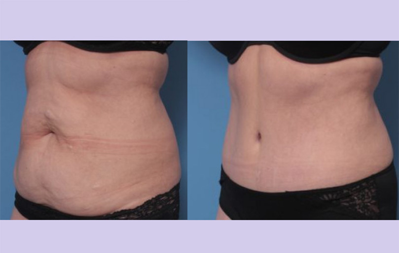 Before and After Image: Abdominoplasty – Tummy Tuck – Case 40 - left-front-oblique