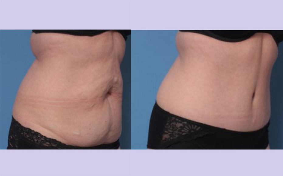 Before and After Image: Abdominoplasty – Tummy Tuck – Case 40 - right-front-oblique