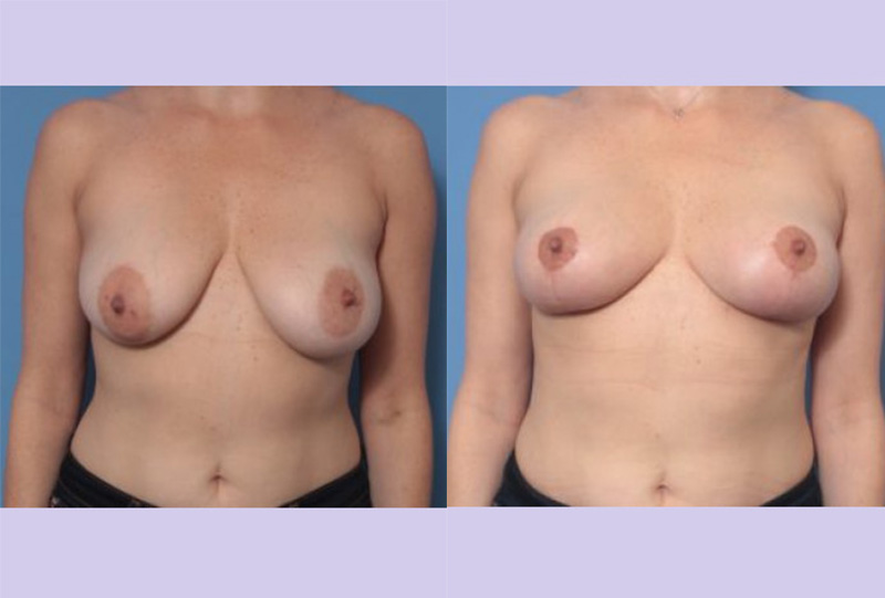 Before and After Image: Breast Lift- Case 25 - front