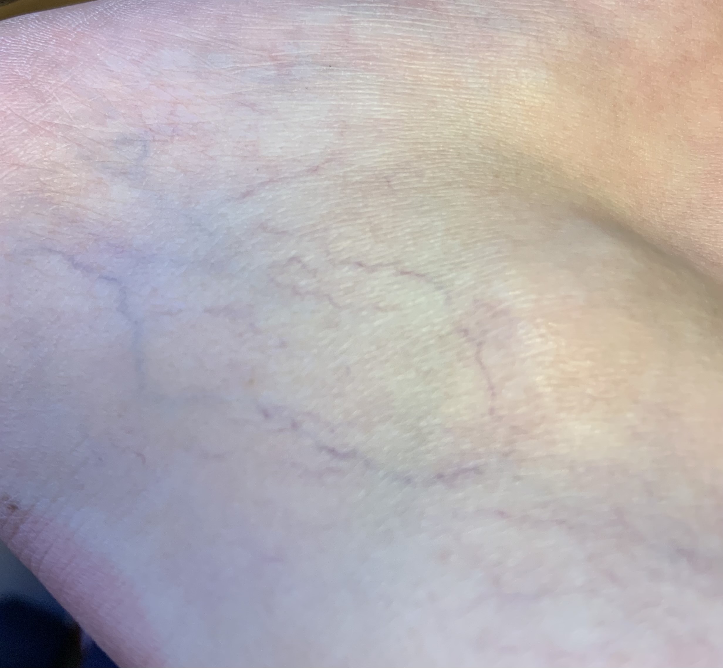 Spider veins