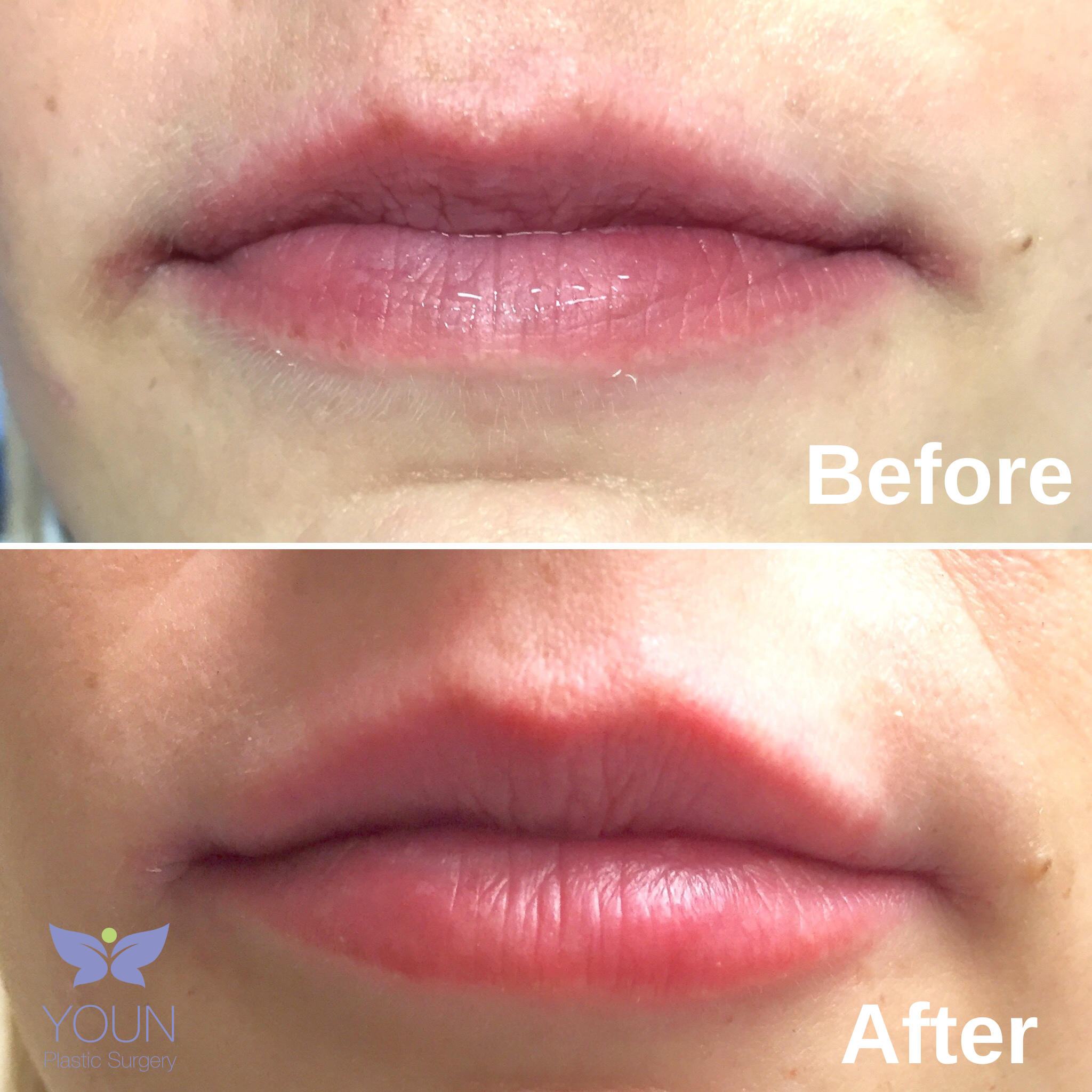 Lip Filler Before and After (1)