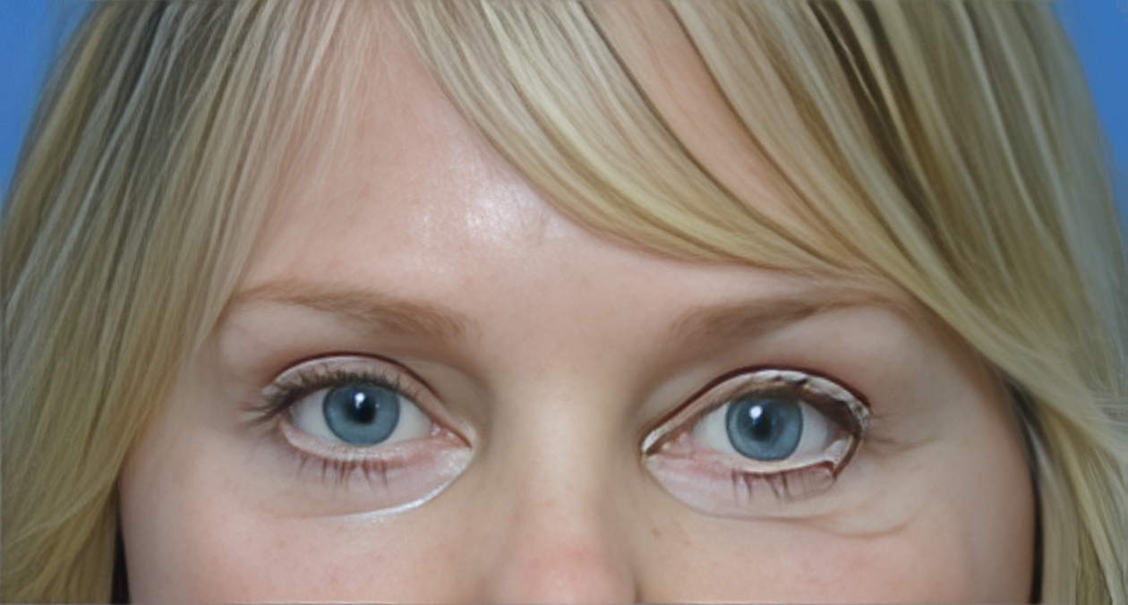 EyelidLift After 1Edit