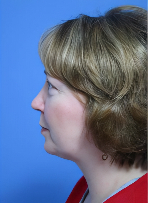 SubLiposuction After 1Edit