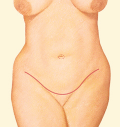Tummy Tuck 02