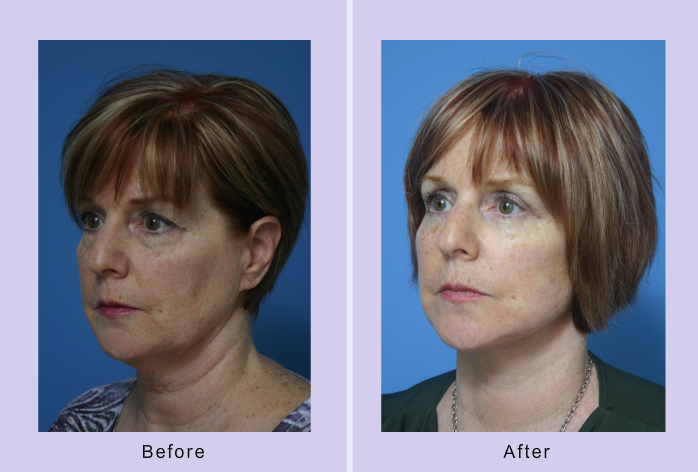 Before and After Image: Lower Facelift – Case 20 - left-front-oblique