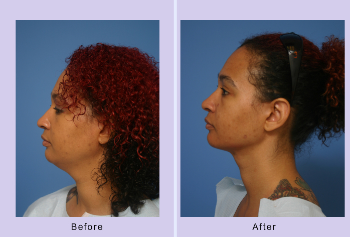 Before and After Image: submental liposuction – case 4 - left-side