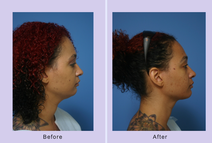 Before and After Image: submental liposuction – case 4 - right-side