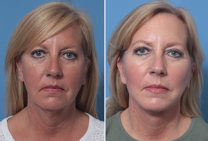 Before and After Image: 3-D Volumetric Facelift – Case 17 - front