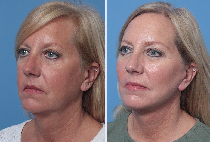 Before and After Image: 3-D Volumetric Facelift – Case 17 - left-front-oblique