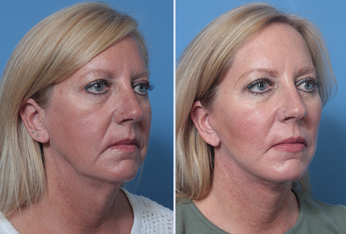 Before and After Image: Facial Fat Grafting – Case 15 - right-front-oblique