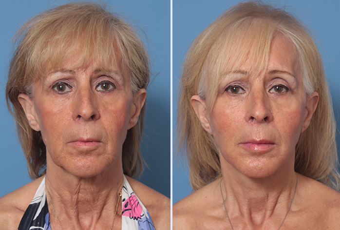 Before and After Image: 3-D Volumetric Facelift – Case 18