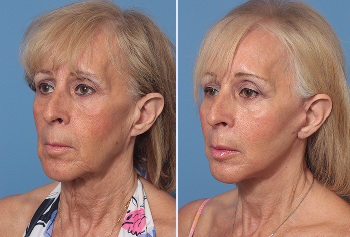 Before and After Image: Facial Fat Grafting – Case 16 - left-front-oblique