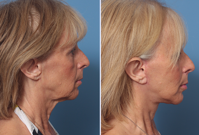 Before and After Image: 3-D Volumetric Facelift – Case 18 - right-side