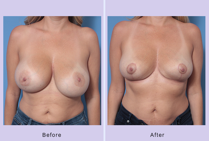 Before and After Image: Breast Implant Removal – Case 3