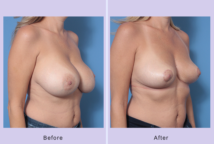 Before and After Image: Breast Implant Removal – Case 3 - right-front-oblique