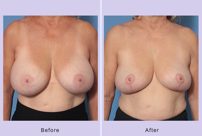 Before and After Image: Breast Implant Removal – Case 4