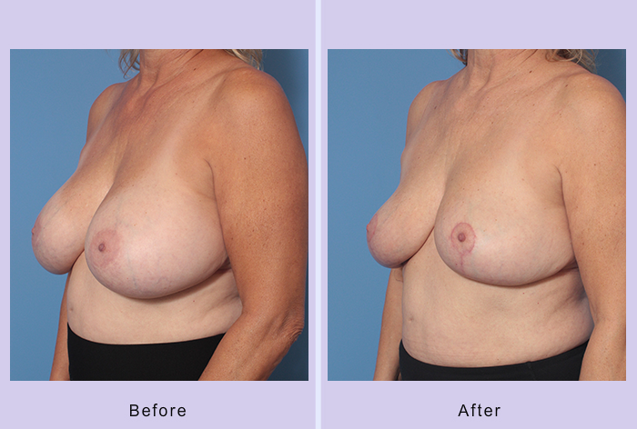 Before and After Image: Breast Implant Removal – Case 4 - left-front-oblique