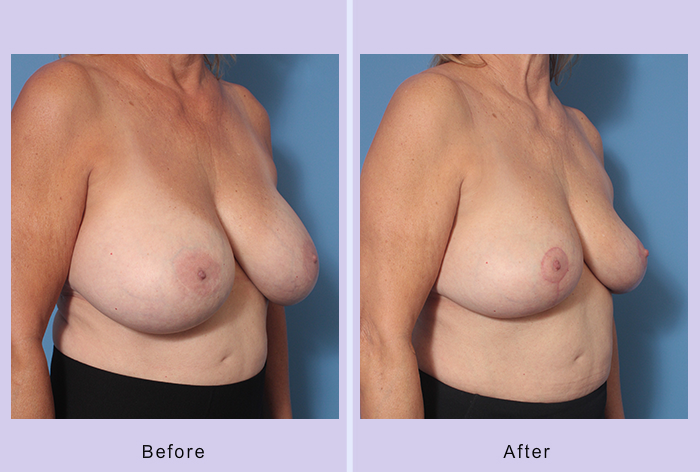 Before and After Image: Breast Implant Removal – Case 4 - right-front-oblique