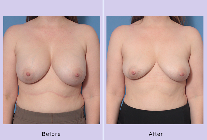 Before and After Image: Breast Implant Removal – Case 5