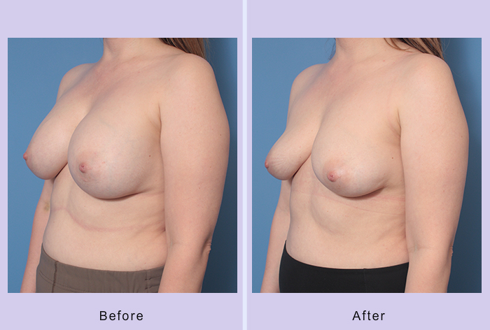 Before and After Image: Breast Implant Removal – Case 5 - left-front-oblique