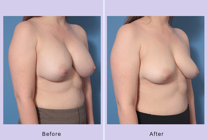 Before and After Image: Breast Implant Removal – Case 5 - right-front-oblique