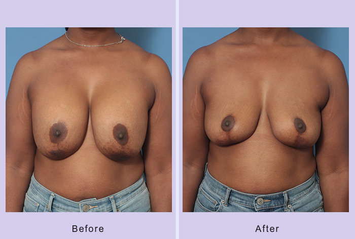 Before and After Image: Breast Implant Removal – Case 6 - front