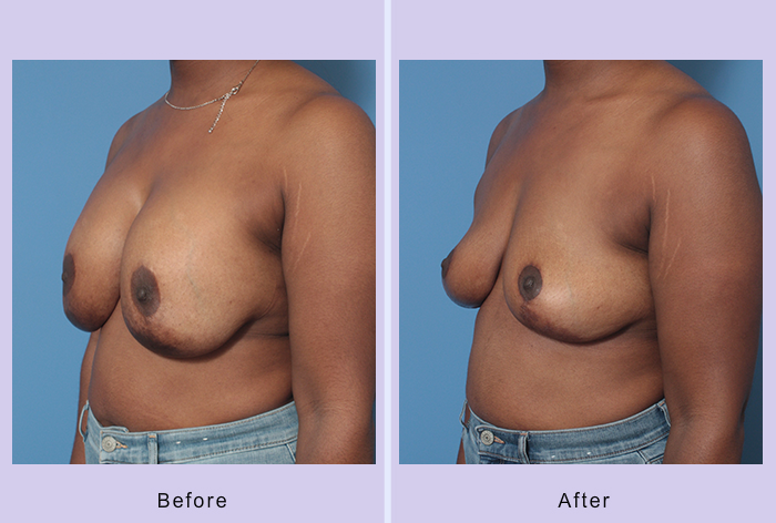 Before and After Image: Breast Implant Removal – Case 6 - left-front-oblique