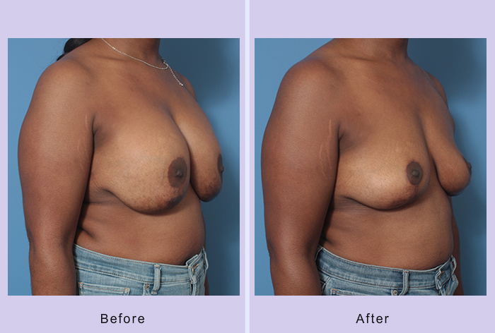 Before and After Image: Breast Implant Removal – Case 6 - right-front-oblique