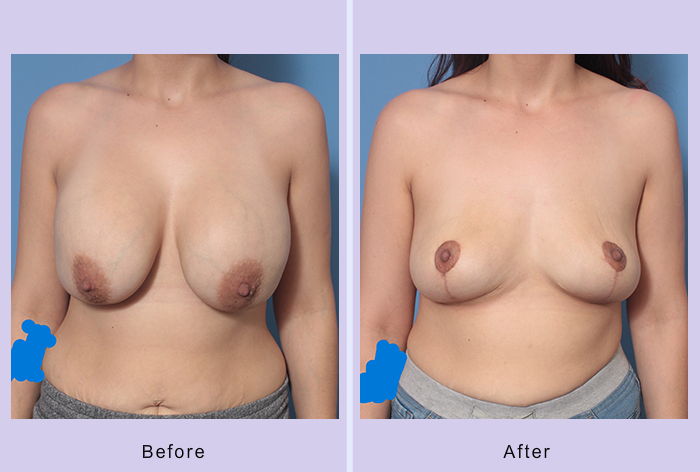 Before and After Image: Breast Implant Removal – Case 7 - front