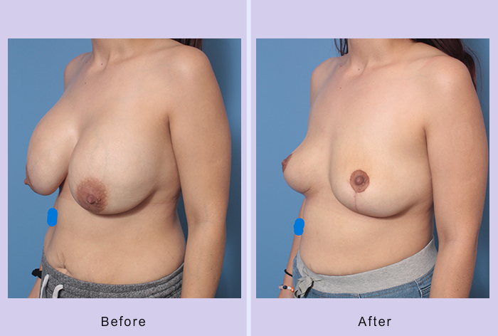 Before and After Image: Breast Implant Removal – Case 7 - left-front-oblique